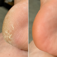 Callus Removing Power